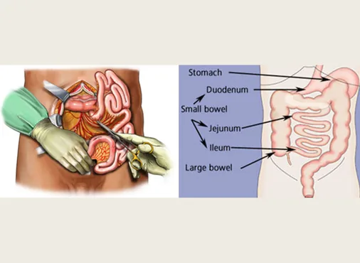 Small Bowel Tumour Surgery consultation at Niraaya Hospital